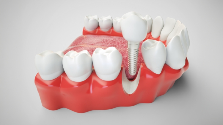 3D illustration of a dental implant in the lower jaw, showing the metal post anchored in the jawbone with a crown attached, surrounded by natural teeth.